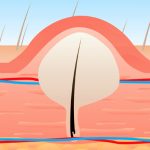 642x361_Treating_and_Preventing_Ingrown_Vaginal_Hair